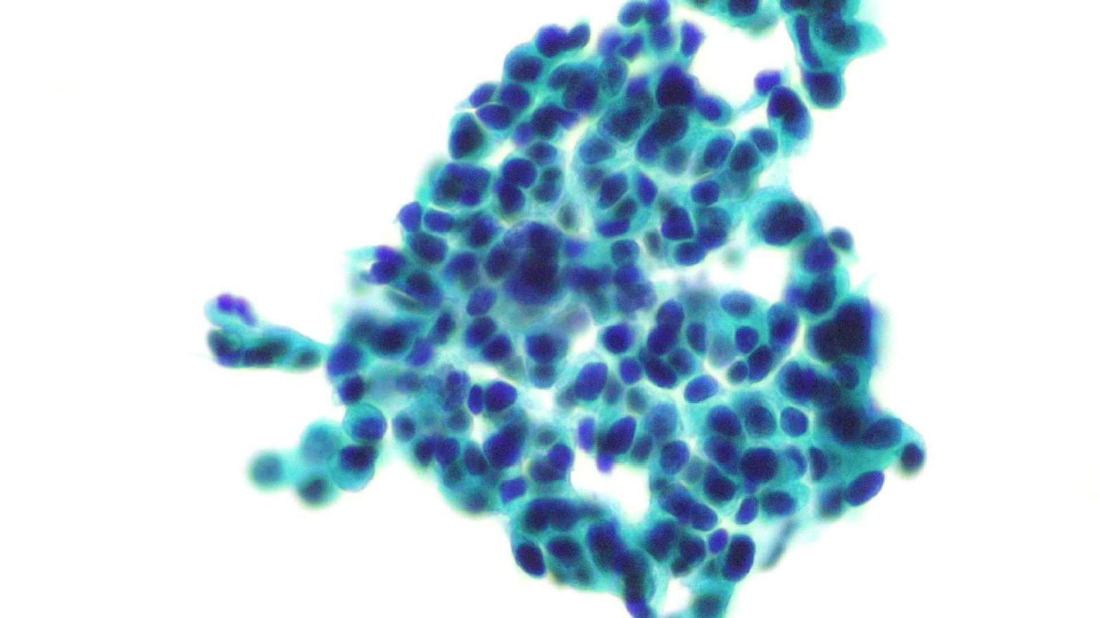 ニコン顕微鏡Eclipse Si サンプル画像 膀胱がん グロコット染色