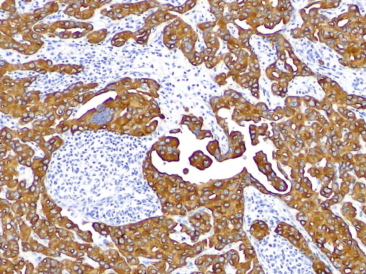 Eclipse Si サンプル画像 乳がん サイトケラチン免疫染色